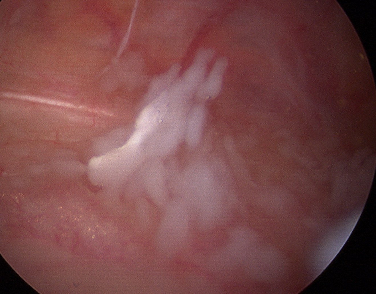 Knee Chondromatosis